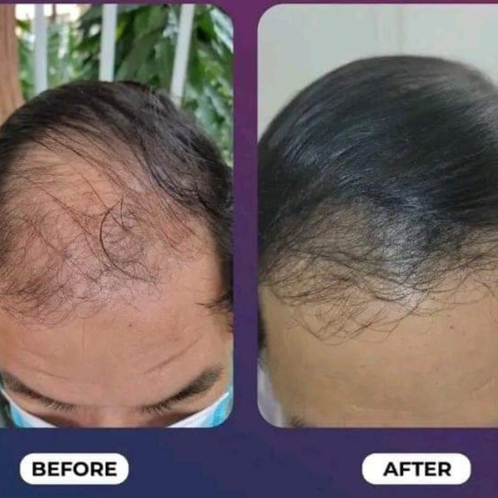 RupaKesa Adivasi Herbal Hair Oil (1 L) - Kreate- Hair Oil