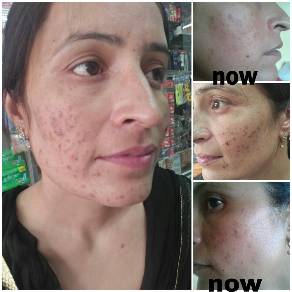 
                  
                    PalviT Face Serum Treatment for Acne, Pimples, Redness & Uneven Skin Tone (30ml)
                  
                
